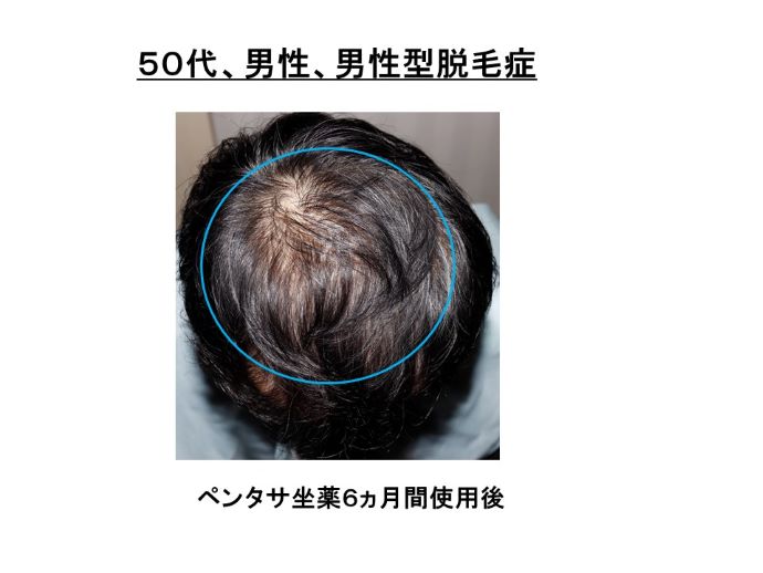 円形脱毛症　病院